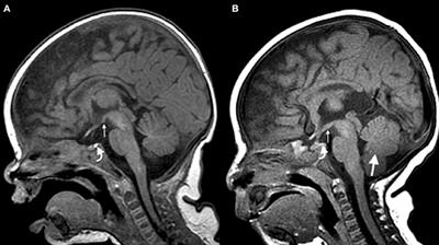 Hyponatremia: An Unusual Presentation in a Neonate With Chromosome 1q21.1 Deletion Syndrome